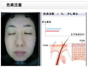 色素沈着