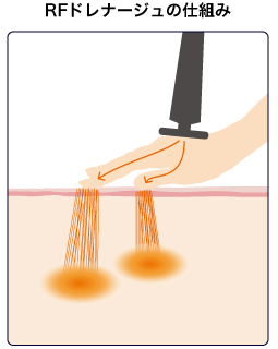 RFドレナージュの仕組み